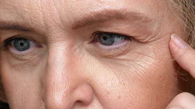middle aged female's eye with drooping eyelid with patch for eyes. Ptosis is a drooping of the upper eyelid, lazy eye. Cosmetology and facial concept, first wrinkles