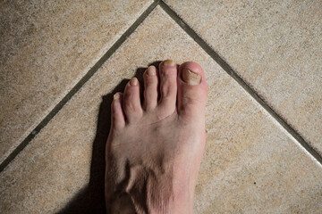 Micose com infe&ccedil;&atilde;o f&uacute;ngica em todas as unhas do p&eacute;.