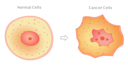 Cancer cell and healthy, normal. cell Cancerous cells have unique features, including a large nucleus with an irregular shape and prominent nucleoli. Vector illustration