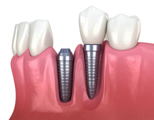 Dental model showing a tooth implant being inserted, and one already installed