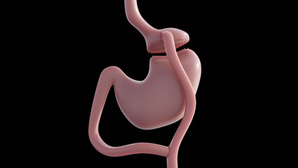 A 3d image illustrates gastric bypass surgery that change digestive system to help lose weight. Major type of weight-loss (bariatric) surgery.