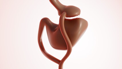 A 3d image illustrates gastric bypass surgery that change digestive system to help lose weight. Major type of weight-loss (bariatric) surgery.