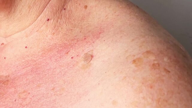 Senior woman with moles, papillomas and pigmentation spots on her shoulder, skin cancer, malignant tumor prevention, health care, oncology risk, dermatology disease concept.