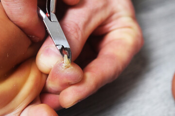 Foot skin care. Cutting old skin from your finger with scissors
