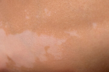 Fototapeta premium Skin with vitiligo. Female legs and arms with autoimmune disease. depigmentation