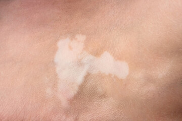 Skin with vitiligo. Female legs and arms with autoimmune disease. pigmentation
