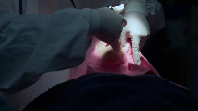 A dental team is injecting local anesthesia with a sterile syringe before performing an impacted wisdom tooth extraction surgery in the mouth.