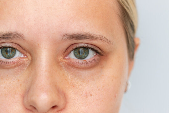 Close-up of a tired young woman's eyes with dark circles and pigmentation spots. Natural skin texture, no makeup. Real beauty and skincare awareness concept