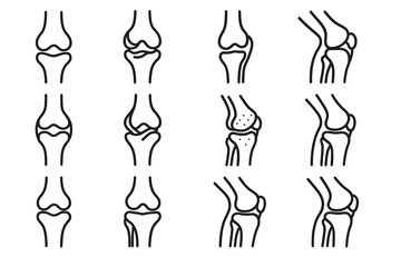 Knee joint diagrams: healthy vs. arthritic conditions in side and front views
