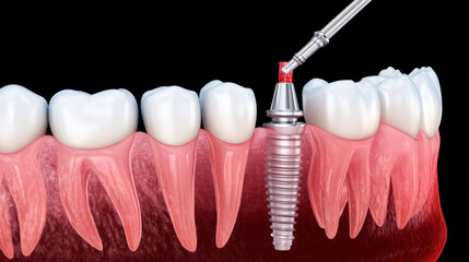Dental implant procedure performing in jaw bone, dentistry concept