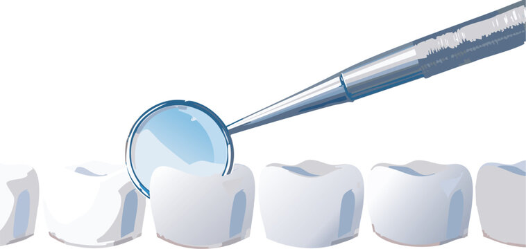 Tooth examination using explorer on occlusal surface of premolar
