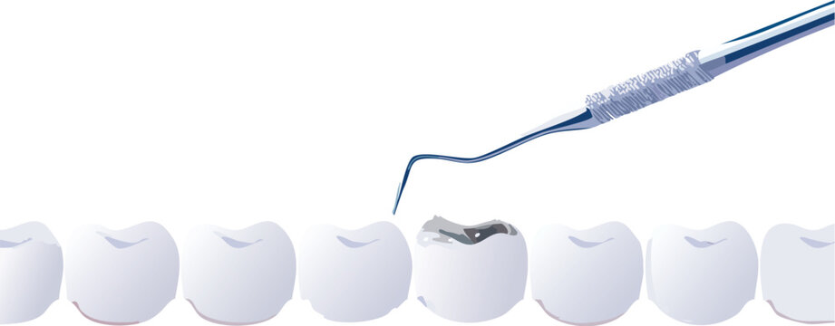 Close up dental illustration of explorer probing premolar surface

