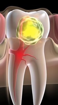 3D animation of a painful dental abscess at the root of a tooth. Infection.