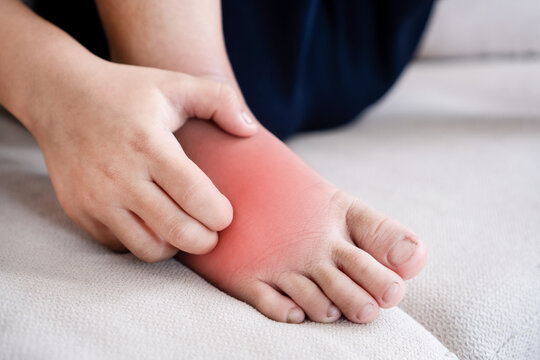 Asian boy scratching his feet with redness and itching caused by kin itching hand scratching allergic. Close-up view of a child&rsquo;s leg showing skin rash, swelling, and allergic reaction to insect.