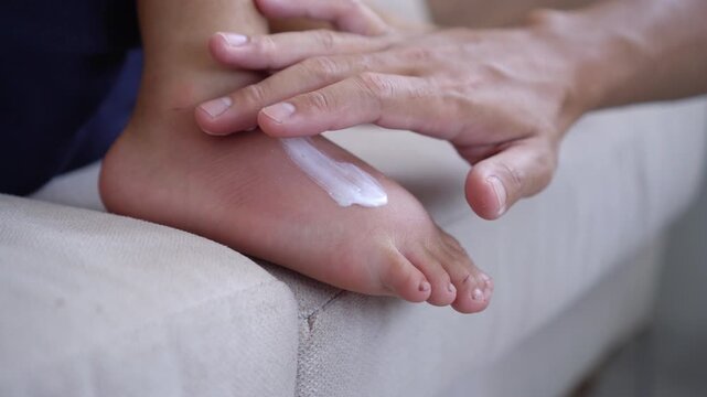 Close-up of a dad&rsquo;s hand applying soothing cream to his child&rsquo;s skin with redness, swelling, irritation,  inflammation, skin allergies, insect bites, and itching from an allergic reaction
