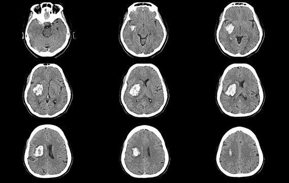 CT scan brain image showing intracerebral hemorrhage stroke