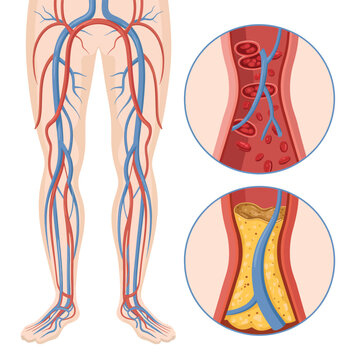 Illustration of healthy and diseased leg arteries and veins