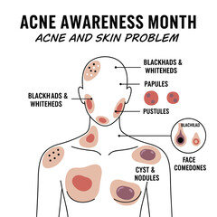 Fototapeta premium During Acne Awareness Month, we address acne and skin issues, including body acne types such as blackheads, whiteheads, papules, pustules, cysts, nodules, and facial comedones