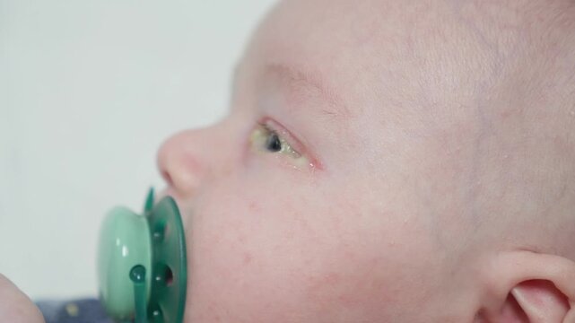 Baby eyes with eye mucus in selective focus. Disease tear ducts tons of newborns close up. Nasolacrimal duct obstruction in baby it is a blockage of the lacrimal drainage system. 