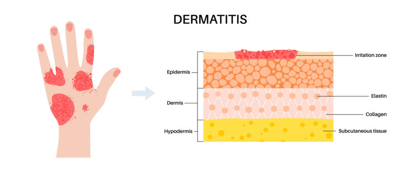 Dermatitis skin disease