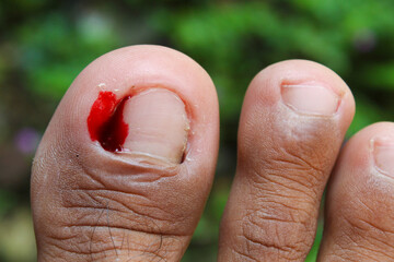 close up of a wound on a toe with a bleeding nail due to injury or ingrown nail (hangnail)