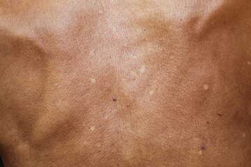 Naklejka premium The texture of a man's back with brown skin that appears to have white patches due to skin pigmentation disorders