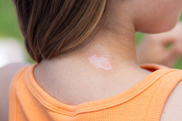 Child with vitiligo patch on neck wearing orange tank top outdoors