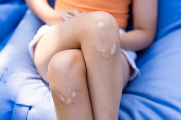 Young girl with vitiligo on her legs sitting on a blue inflatable chair outdoors