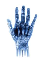 Naklejka premium Human Hand Skeleton X Ray Blue Tones Isolated On Black anatomy bone