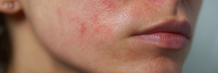 Fototapeta premium Close up of cheek with red acne spots and irritated skin showing inflammation and blemishes on young adult face