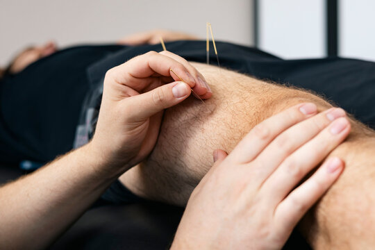 Physiotherapist doing dry needling therapy on male leg, acupuncture.