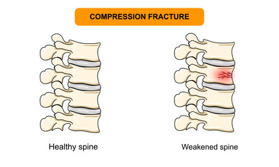 spinal compression fracture. Vertebral compression fracture, back pain, osteoporosis. Vector illustration for medical, clinical, or educational posters.