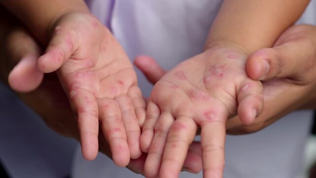 Hand, foot and mouth disease HFMD Human hand of scarlet fever in coxsackievirus palmarosa virus and child hand on white background