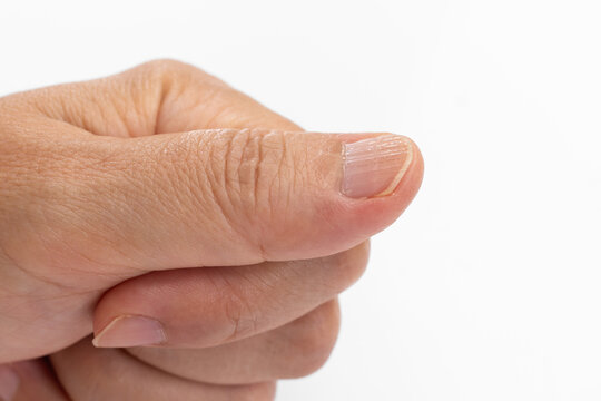 Vertical ridges on nails, also known as onychorrhexis.