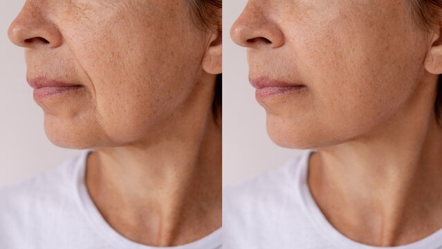 Before and after close-up of a mature woman&rsquo;s lower face and jawline, showing visible skin improvement, reduced wrinkles and smoother texture. Anti-aging or skincare concept. Facelift, plastic surgery