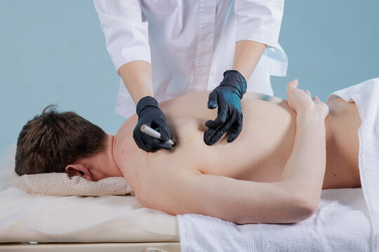 Therapist marking acupoints on male back before dry needling in clean clinic