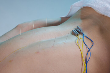 Electroacupuncture needles and electrodes on back for pain therapy
