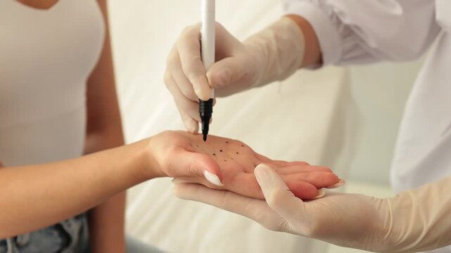 4k video marking dotes for filler injection on the palm of a patient against hyperhidrosis. Markup of the hyperhidrosis treatment. Care of palm sweating.
