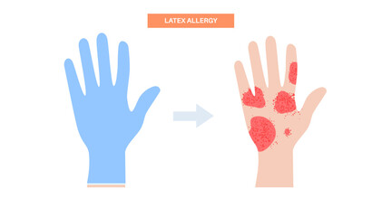 Latex allergy inflammation