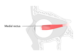 Medial rectus - Human eye muscle depicted in labeled anatomy chart, controls inward movement of the eyeball, critical in eye coordination and vision function education.