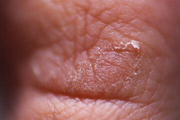 Macro shot of dried toe skin due to eczema