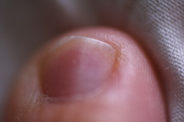 Macro shot of dried toe skin due to eczema