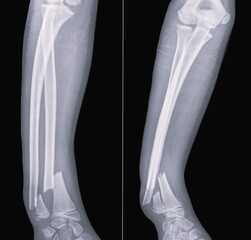 x ray image of distal radius fracture, and ulna fractures, broken hand ,
