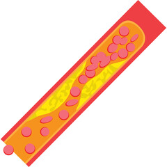 An Isometric Illustration Depicts Red Blood Cells Flowing Through A Diseased Artery With Plaque Buildup And Orange Yellow Background On Transparent Background