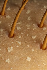 Dry flaky scalp close up with hair strands and dandruff flakes