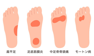 足裏の痛み　炎症が起きる箇所