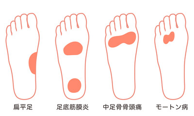 足裏の痛み　炎症が起きる箇所