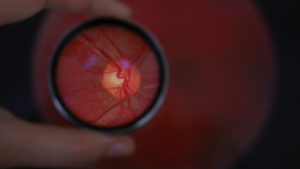 View of optic disc during examination of retina while holding 20 diopter lens. A routine fundus...