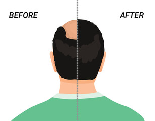 Male head before and after hair transplant or hair loss treatment back view