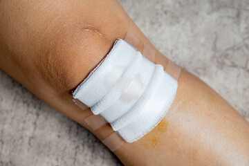 Bandaged Knee with Medical Gauze, Knee wound, close-up, injured knee with gauze and medical tape after first aid treatment